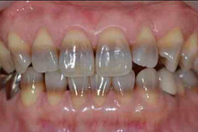 Tetracycline teeth stains