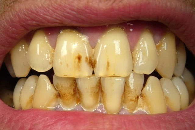 Teeth stains due to tobacco smoking